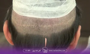 تفاوت قیمت کاشت مو fut در تهران و سایر شهرها