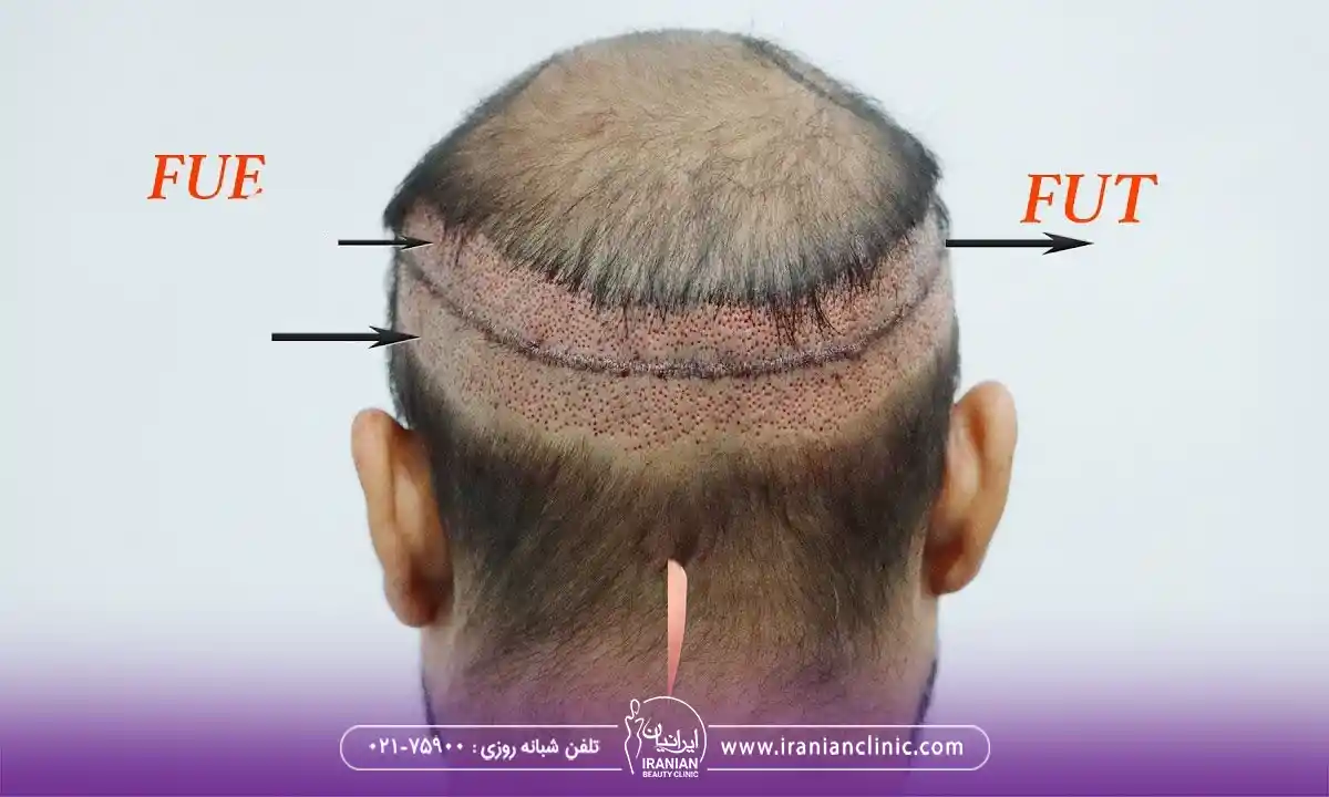 عوامل مؤثر بر هزینه کاشت مو به روش fut