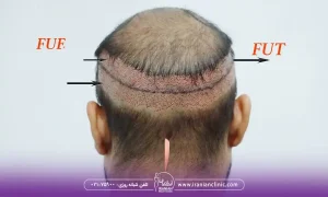 عوامل مؤثر بر هزینه کاشت مو به روش fut