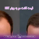 قیمت کاشت مو به روش hrt و هزینه کاشت مو به روش HRT