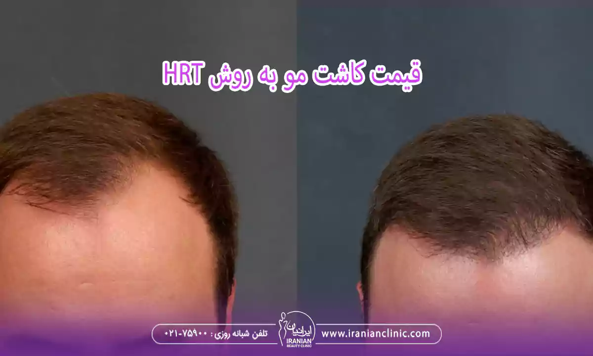 قیمت کاشت مو به روش hrt و هزینه کاشت مو به روش HRT