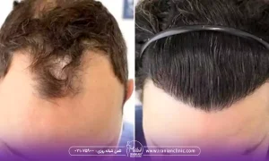 عوامل مؤثر بر هزینه کاشت مو به روش hrt