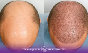 قیمت هر گرافت و هر تار مو در روش FIT