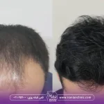 هزینه کاشت مو میکروگرافت و قیمت کاشت مو به روش میکروگرافت