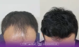 هزینه کاشت مو میکروگرافت و قیمت کاشت مو به روش میکروگرافت