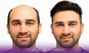 قیمت هر گرافت و هر تار مو در روش میکروگرافت