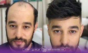 عوامل مؤثر بر هزینه کاشت مو به روش میکروگرافت