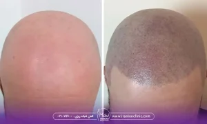 نتایج کاشت مو به روش FUT بهتر است یا FIT