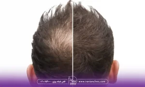کدام روش کاشت مو ارزان تر از کاشت مو به روش SUT است؟