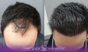 قیمت کاشت مو به روش SUT در سال ۱۴۰۴ چقدر است؟