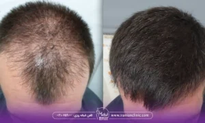 قیمت کاشت مو به روش sut و هزینه کاشت مو به روش SUT