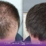 قیمت کاشت مو به روش sut و هزینه کاشت مو به روش SUT