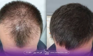 قیمت کاشت مو به روش sut و هزینه کاشت مو به روش SUT