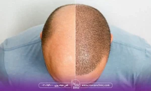 کاشت مو به روش FUT و FIT کدام روش بهتر است؟