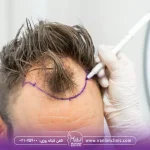 men-hair-transplant-cost