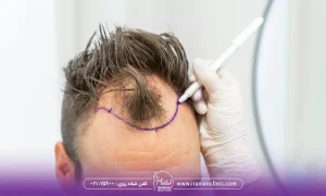 men-hair-transplant-cost