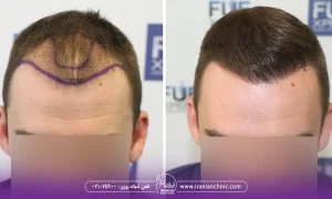 هزینه کاشت مو مردان با توجه به روش کاشت