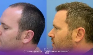 عوامل مؤثر بر هزینه کاشت مو شقیقه، عکس اقا با کاشت مو شقیقه