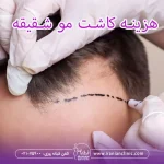 هزینه کاشت مو شقیقه و قیمت کاشت مو شقیقه