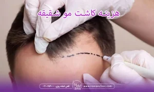 هزینه کاشت مو شقیقه و قیمت کاشت مو شقیقه