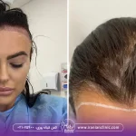 قیمت کاشت مو برای زنان و هزینه کاشت مو زنان