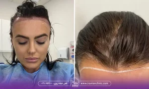 قیمت کاشت مو برای زنان و هزینه کاشت مو زنان