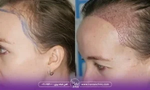 قیمت هر گرافت و هر تار مو شقیقه، عکس خانمی که کاشت مو شقیقه داشته