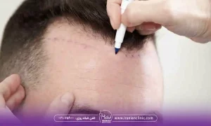 قیمت هر گرافت و هر تار مو در روش fue