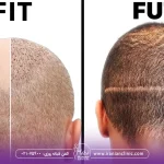 کاشت مو به روش fit بهتر است یا fut