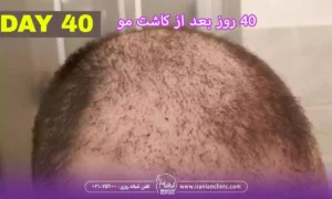 40 روز بعد از کاشت مو