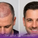 40 روز بعد از کاشت مو