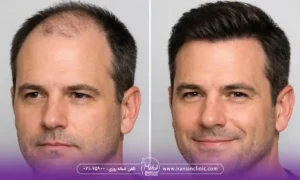 مراقبت های ضروری در روز ۴۰ بعد از کاشت مو