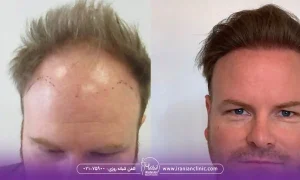 روش های کاشت در بهترین مرکز کاشت مو در سعادت آباد