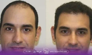 معیارهای انتخاب بهترین مرکز کاشت مو در سعادت آباد