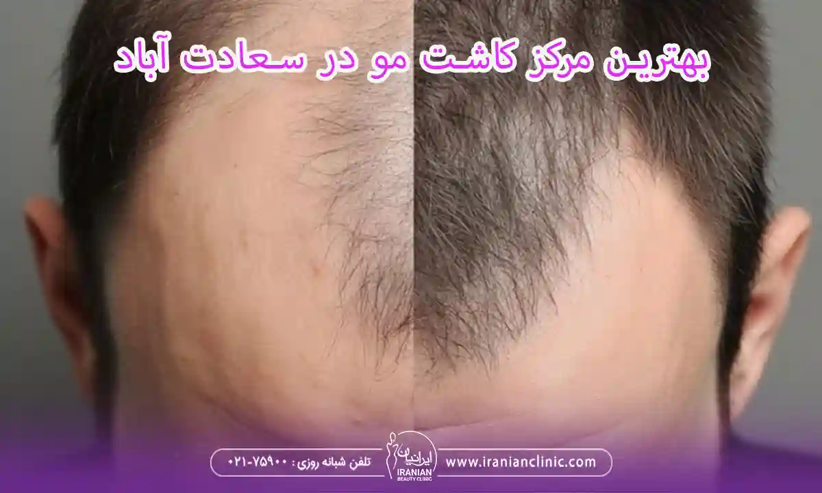 بهترین مرکز کاشت مو در سعادت آباد