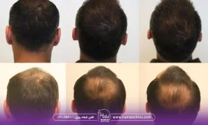 نتیجه واقعی رشد مو بعد کاشت