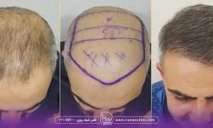 عوامل موثر بر سرعت و کیفیت رشد مو بعد از کاشت