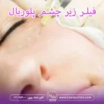 فیلر زیر چشم پلوریال و ژل زیر چشم پلوریال کلاسیک