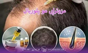 مزوتراپی مو پلوریال
