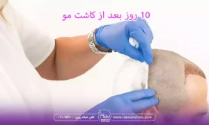 10 روز بعد از کاشت مو و همه چیز درمورد کاشت مو بعد از 10 روز