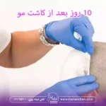 10 روز بعد از کاشت مو و همه چیز درمورد کاشت مو بعد از 10 روز