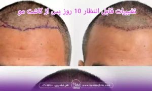 تغییرات قابل انتظار 10 روز پس از کاشت مو