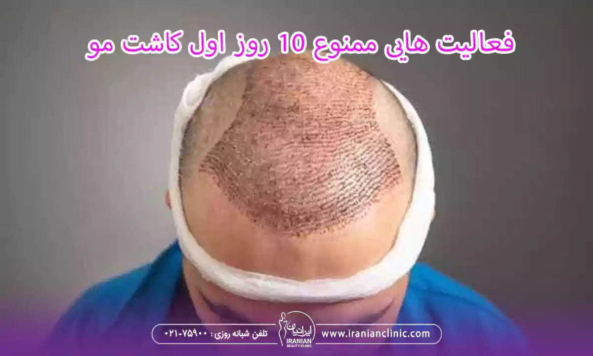 فعالیت هایی ممنوع 10 روز اول کاشت مو و بعد از آن