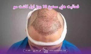 فعالیت هایی ممنوع 10 روز اول کاشت مو و بعد از آن