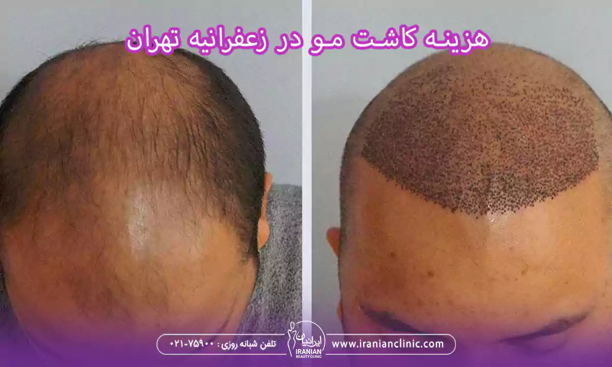 قیمت هر گرافت و هر تار مو در زعفرانیه