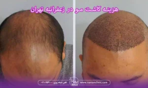 قیمت هر گرافت و هر تار مو در زعفرانیه