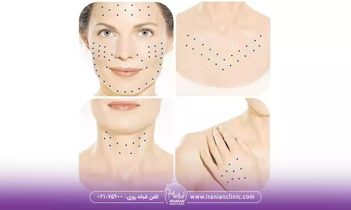 نواحی تحت درمان با تزریق PDRN