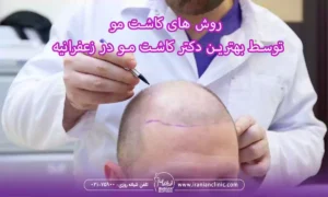 روش های کاشت مو بهترین دکتر کاشت مو در زعفرانیه تهران
