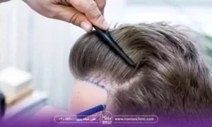 معیارهای انتخاب بهترین مرکز کاشت مو در زعفرانیه تهران