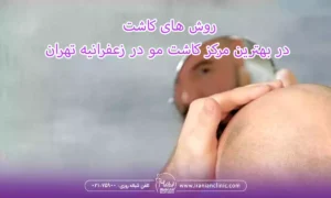 روش های کاشت در بهترین مرکز کاشت مو در زعفرانیه تهران